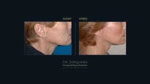 Lifting-cervico-facial-profil