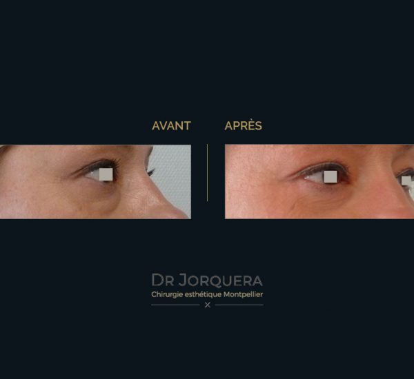 paupiere-inferieur-34D