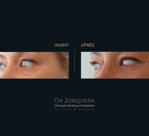 paupiere-inferieur-34G