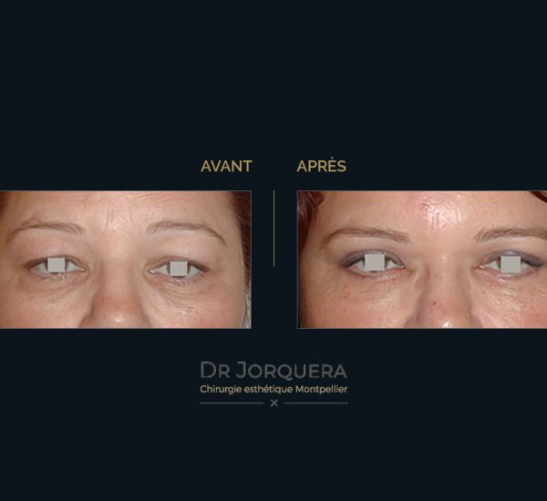 paupiere-inferieursup