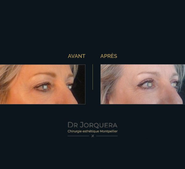 paupiere-sup-femme-34D