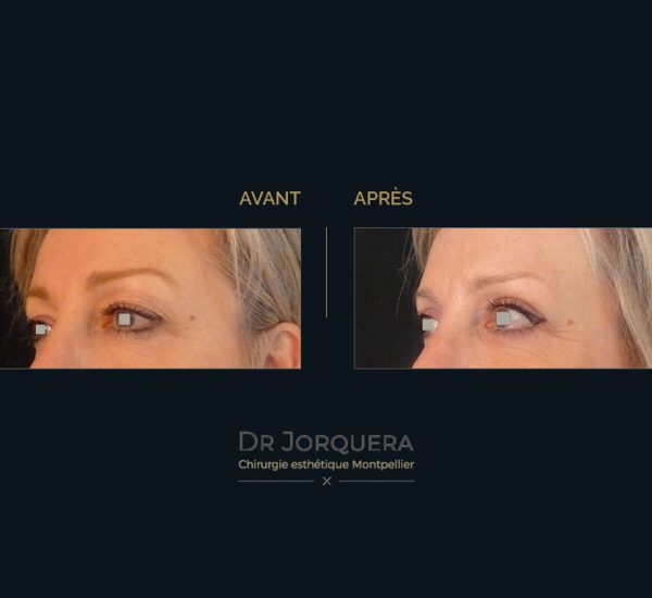 paupiere-sup-femme-34G