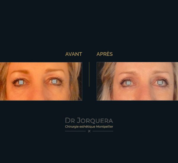 paupiere-sup-femme-face