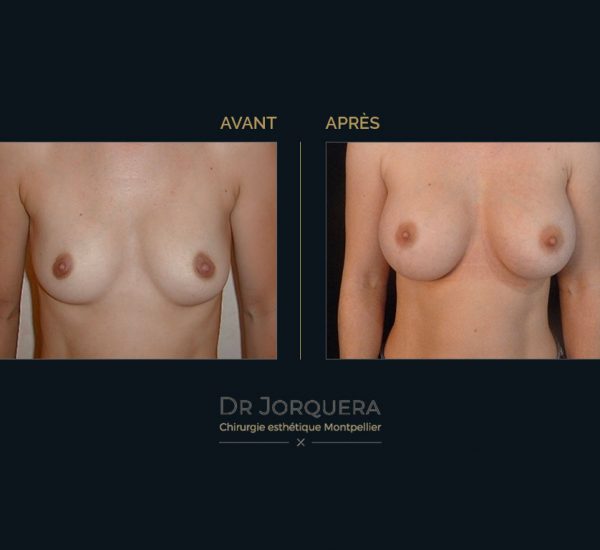 prothese-mamaire-cas2-face