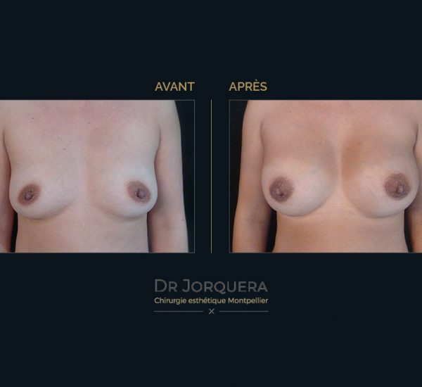 prothese-mamaire-cas3-face