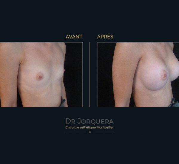 prothese-mamaire-Cas1face-34