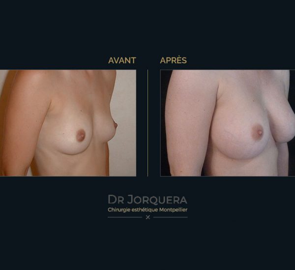 prothese-mamaire-cas2-34