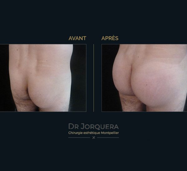 prothese-de-fesse-34