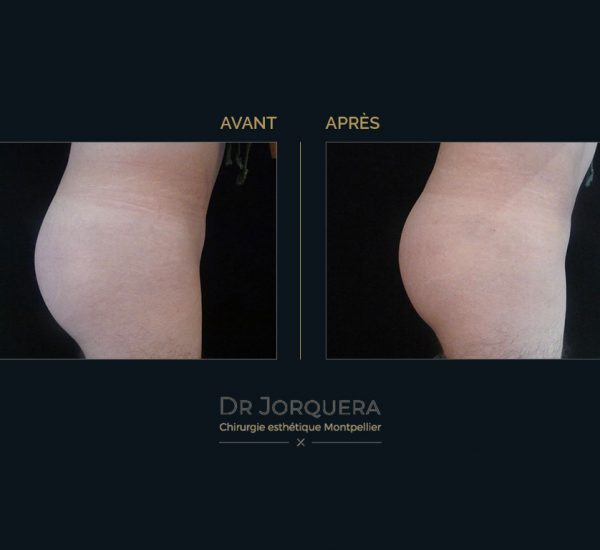 prothese-de-fesse-profil