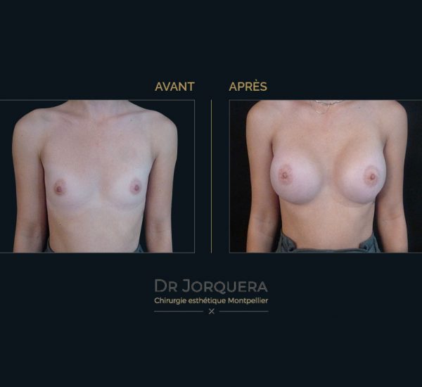 prothese-mamaire-Cas1face