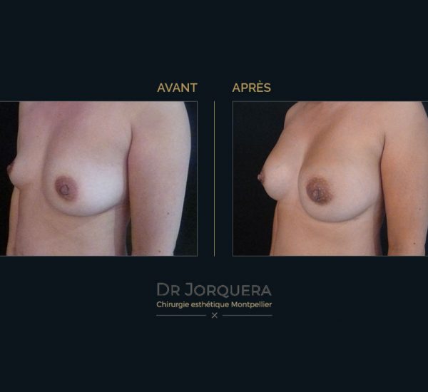 prothese-mamaire-cas3-34G