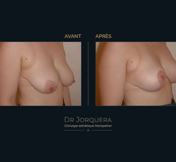 ptose-mamaire-34D