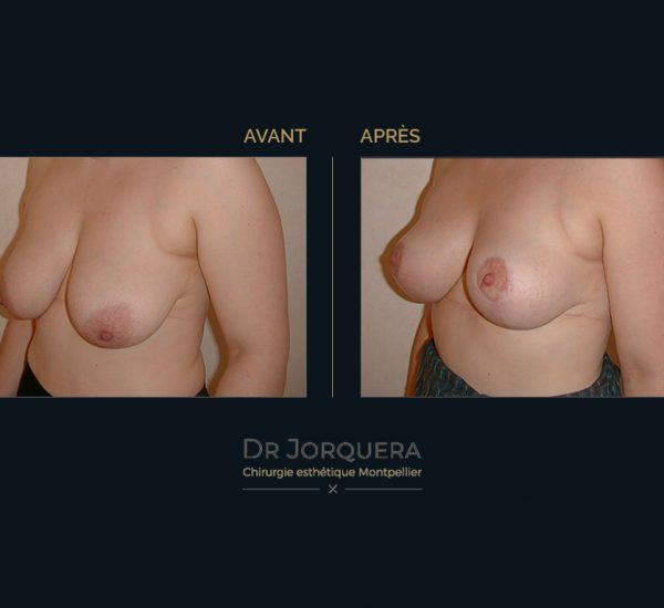 ptose-mamaire-34G