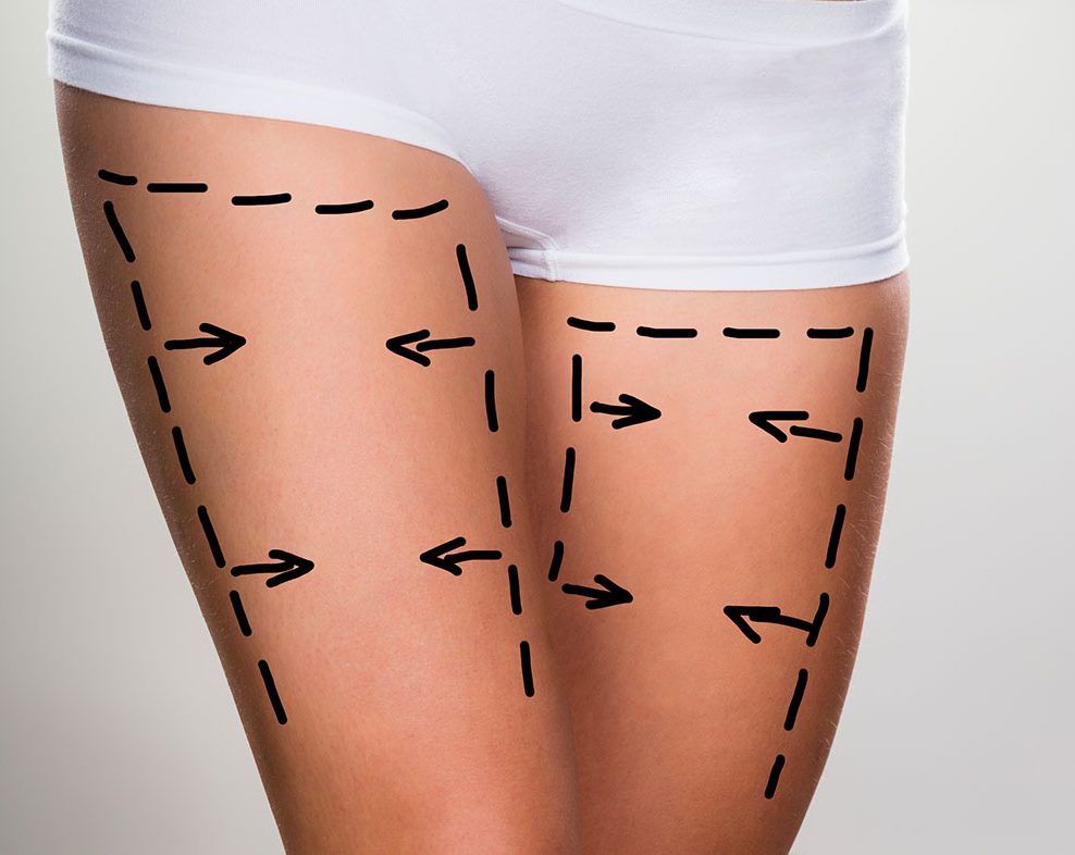 cuisse cuisse