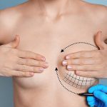 augmentation-mammaire-par-protheses-1