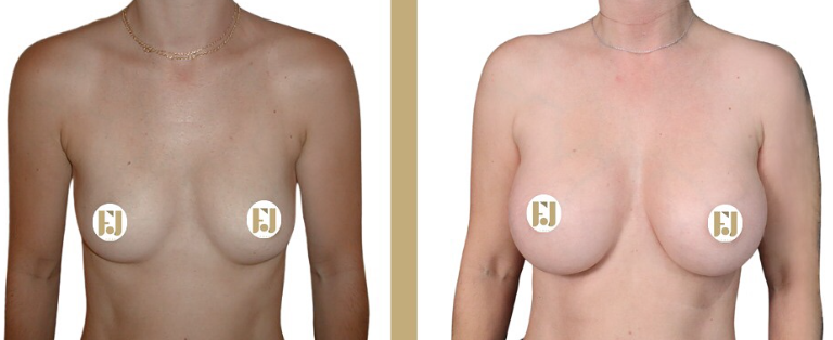 Quel est le prix d’une augmentation mammaire à Montpellier ?