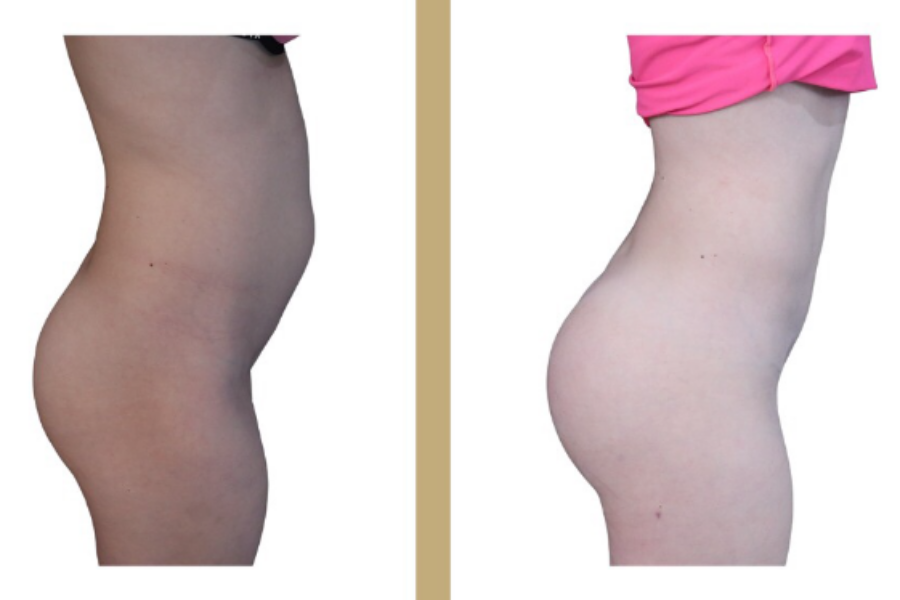 Pose de prothèses de fesses : tout savoir sur cette chirurgie d’embellissement du galbe fessier