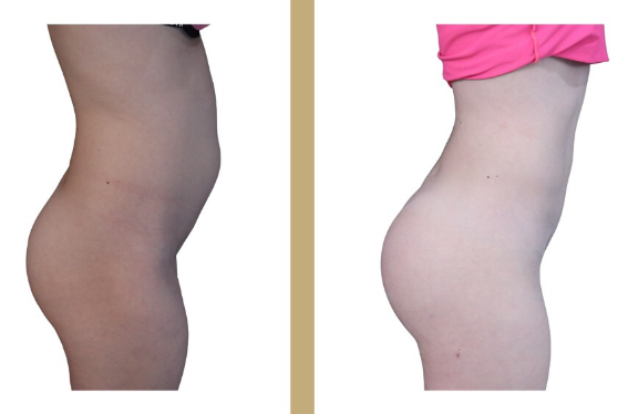 Pose de prothèses de fesses : tout savoir sur cette chirurgie d’embellissement du galbe fessier