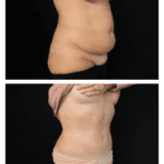 Abdominoplastie à haute tension supérieure et liposuccion postérieure