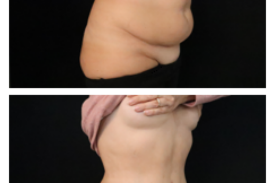 Abdominoplastie à haute tension supérieure et liposuccion postérieure