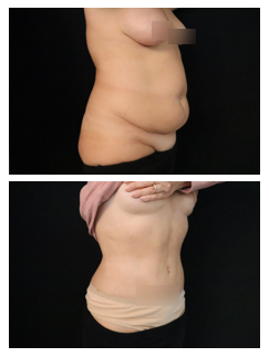 Abdominoplastie à haute tension supérieure et liposuccion postérieure