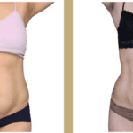 Liposuccion Haute Définition