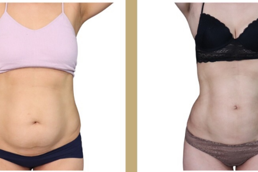 Liposuccion Haute Définition : sculpter la silhouette avec précision