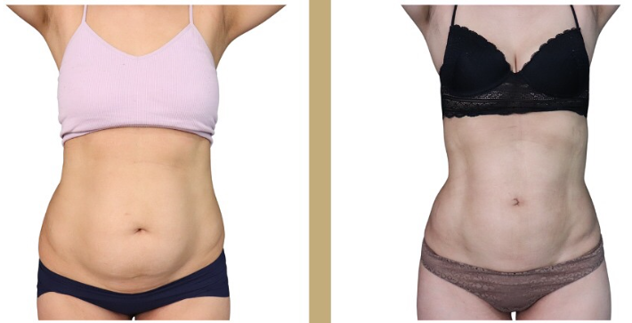 Liposuccion Haute Définition : sculpter la silhouette avec précision