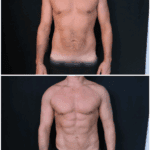 Liposuccion Haute Définition chez l’homme : sculpter, remodeler, sublimer