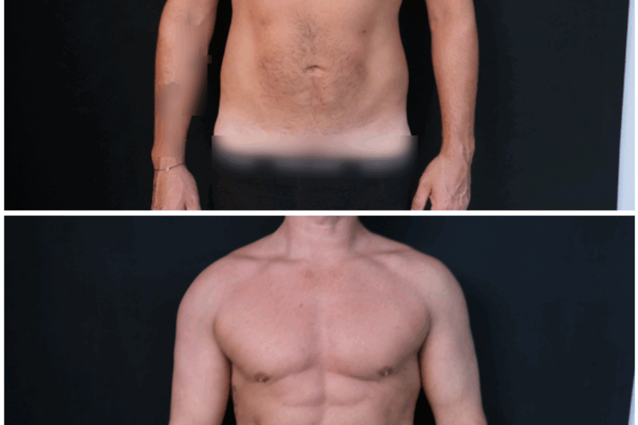 Liposuccion Haute Définition chez l’homme : sculpter, remodeler, sublimer