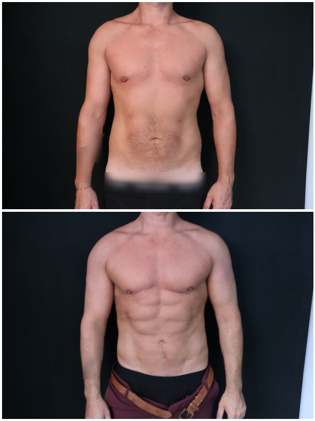 Liposuccion Haute Définition chez l’homme : sculpter, remodeler, sublimer