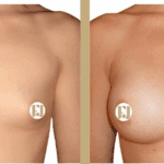 augmentation mammaires Montpellier