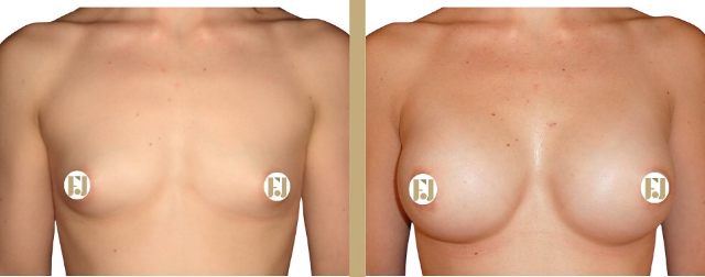 Implants mammaires et sensation du mamelon : ce qui change vraiment